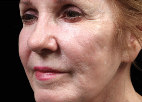 Exion_PIC_Ba-card-cheek-female-004_FRF_Before_ENUS100_1688740545_original