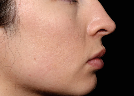 Exion_PIC_Ba-card-cheek-female-040_FRF_After_ENUS100_1688740546_original