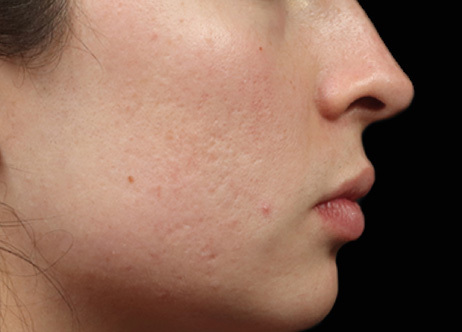 Exion_PIC_Ba-card-cheek-female-040_FRF_Before_ENUS100_1688740546_original