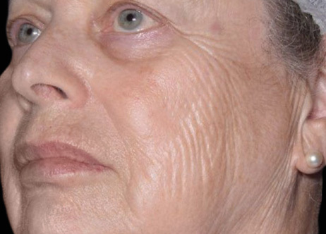 Exion_PIC_Ba-card-cheek-female-061_FRF_Before_ENUS100_1688738381_original