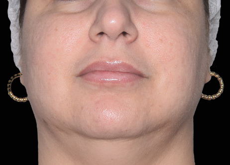 Exion_PIC_Ba-card-cheek-female-069_FRF_After_ENUS100_1688738382_original