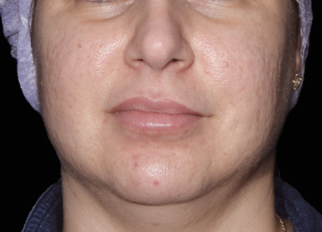 Exion_PIC_Ba-card-cheek-female-069_FRF_Before_ENUS100_1688738383_original