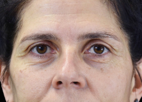 Exion_PIC_Ba-card-eyes-female-010_Face_Before_ENUS100_1688738386_original