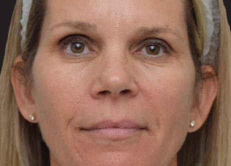 Exion_PIC_Ba-card-face-female-068_FRF_After_ENUS100_1688738394_original