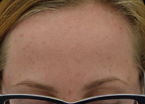 Exion_PIC_Ba-card-forehead-female-064_FRF_After_ENUS100_1688740554_original