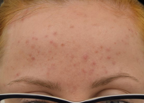 Exion_PIC_Ba-card-forehead-female-064_FRF_Before_ENUS100_1688740553_original