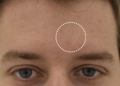 Exion_PIC_Ba-card-forehead-male-022_FRF_After_ENUS100_1688738397_original