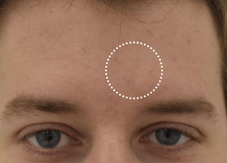 Exion_PIC_Ba-card-forehead-male-022_FRF_After_ENUS100_1688740554_original