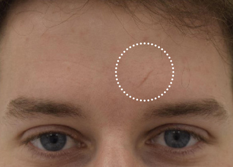 Exion_PIC_Ba-card-forehead-male-022_FRF_Before_ENUS100_1688740554_original