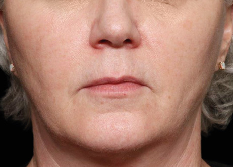 Exion_PIC_Ba-card-mouth-female-015_FRF_After_ENUS100_1688740512_original