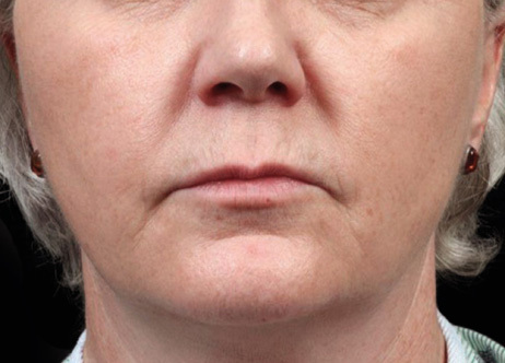 Exion_PIC_Ba-card-mouth-female-015_FRF_Before_ENUS100_1688740511_original