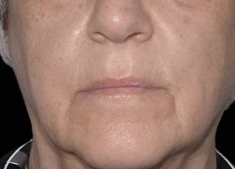 Exion_PIC_Ba-card-mouth-female-060_Face_After_ENUS100_1688740809_original