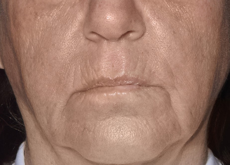 Exion_PIC_Ba-card-mouth-female-060_Face_Before_ENUS100_1688740809_original