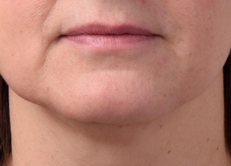 Exion_PIC_Ba-card-neck-female-062_Face_After_ENUS100_1688740811_original