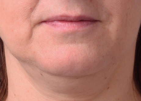 Exion_PIC_Ba-card-neck-female-062_Face_Before_ENUS100_1688740811_original