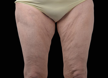 Exion_PIC_Ba-card-thighs-female-033_Body_Before_ENUS100_1688740777_original