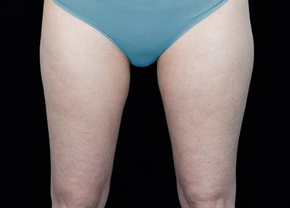 Vanquish_Flex_PIC_010-After-legs-female-BTL-Aesthetics-4TX_412x296px_1590146217_original