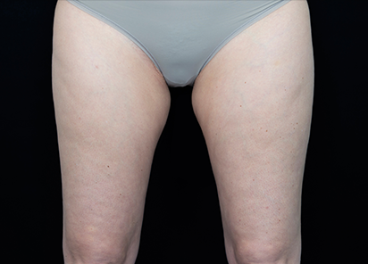 Vanquish_Flex_PIC_010-Before-legs-female-BTL-Aesthetics_412x296px_1590146220_original