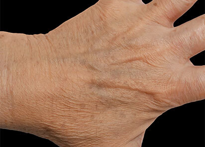 Exion_PIC_088-After-hands-female-BTL-Aesthetics-1M_1726477675_original