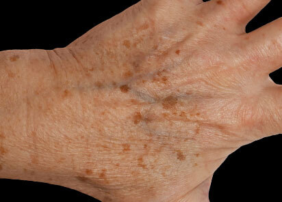 Exion_PIC_088-Before-hands-female-BTL-Aesthetics_412x296px_1726477676_original