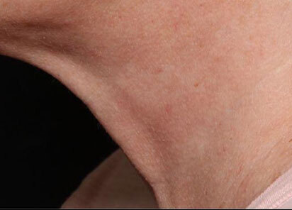 Exion_PIC_097-After-neck-female-Diane-Duncan-MD-1M-1TX_412x296px_1726476268_original