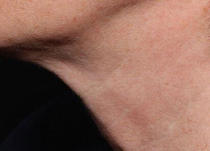 Exion_PIC_097-Before-neck-female-Diane-Duncan-MD_412x296px_1726476268_original